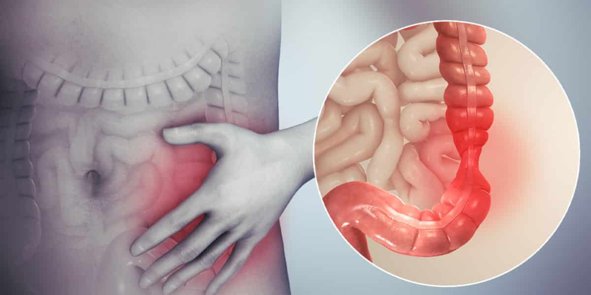 Sindromul de colon iritabil vs. boala inflamatorie intestinală – cum deosebești simptomele