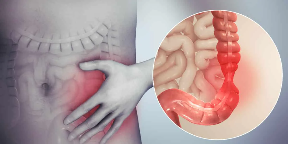 Sindromul de colon iritabil vs. boala inflamatorie intestinală – cum deosebești simptomele